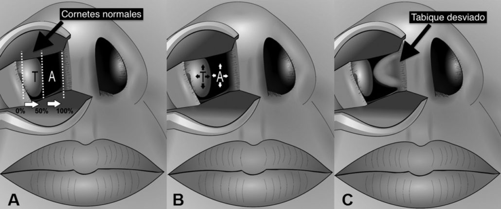 Desviación del tabique nasal - Otorrinolaringologo Guadalajara - Dr Gerardo Lopez Guerra