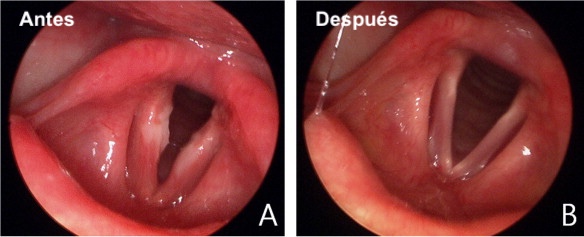 Laringitis Aguda y Crónica: Síntomas, Causas y Tratamiento | Vocalia Otorrinolaringólogos ® Guadalajara