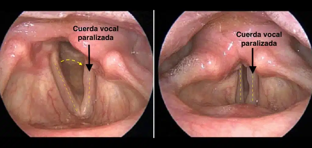 Parálisis Cuerdas Vocales: Tratamiento Avanzado (Laringoplastia, Láser) | Vocalia Otorrinolaringólogos ® Guadalajara