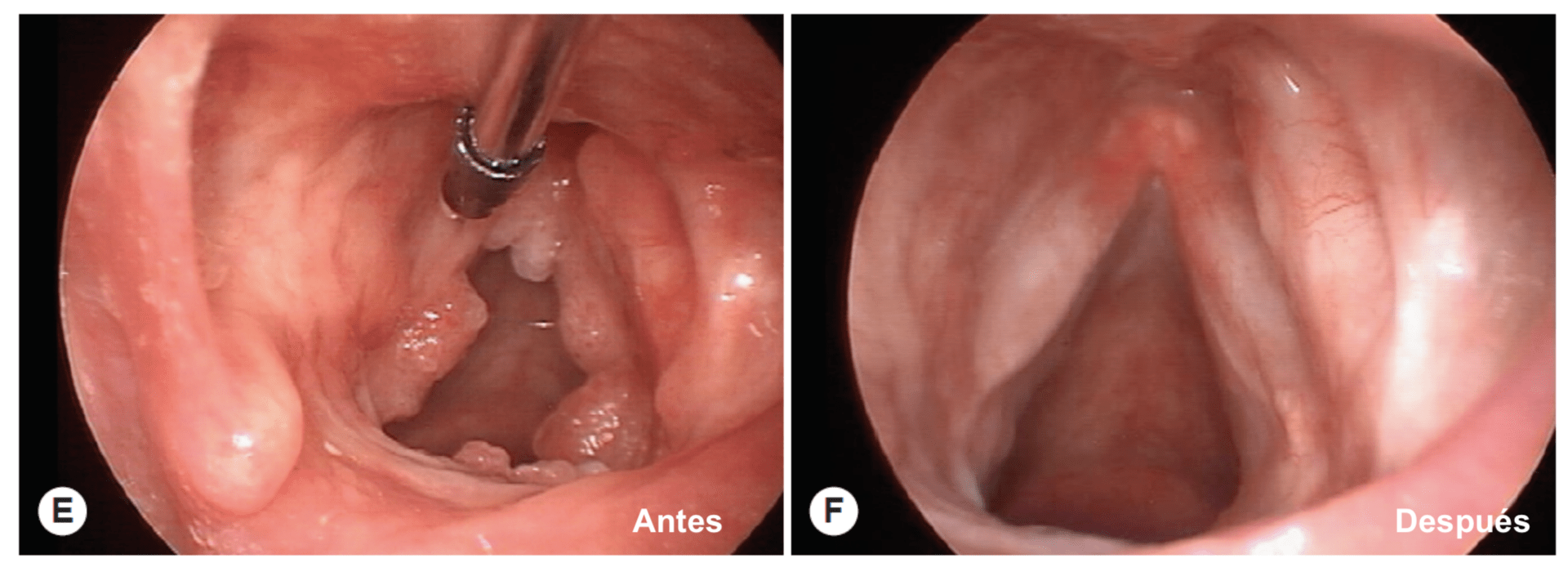 Papiloma Laríngeo (VPH) / PRR: Tratamiento Avanzado Adultos y Niños | Vocalia Otorrinolaringólogos ® Guadalajara