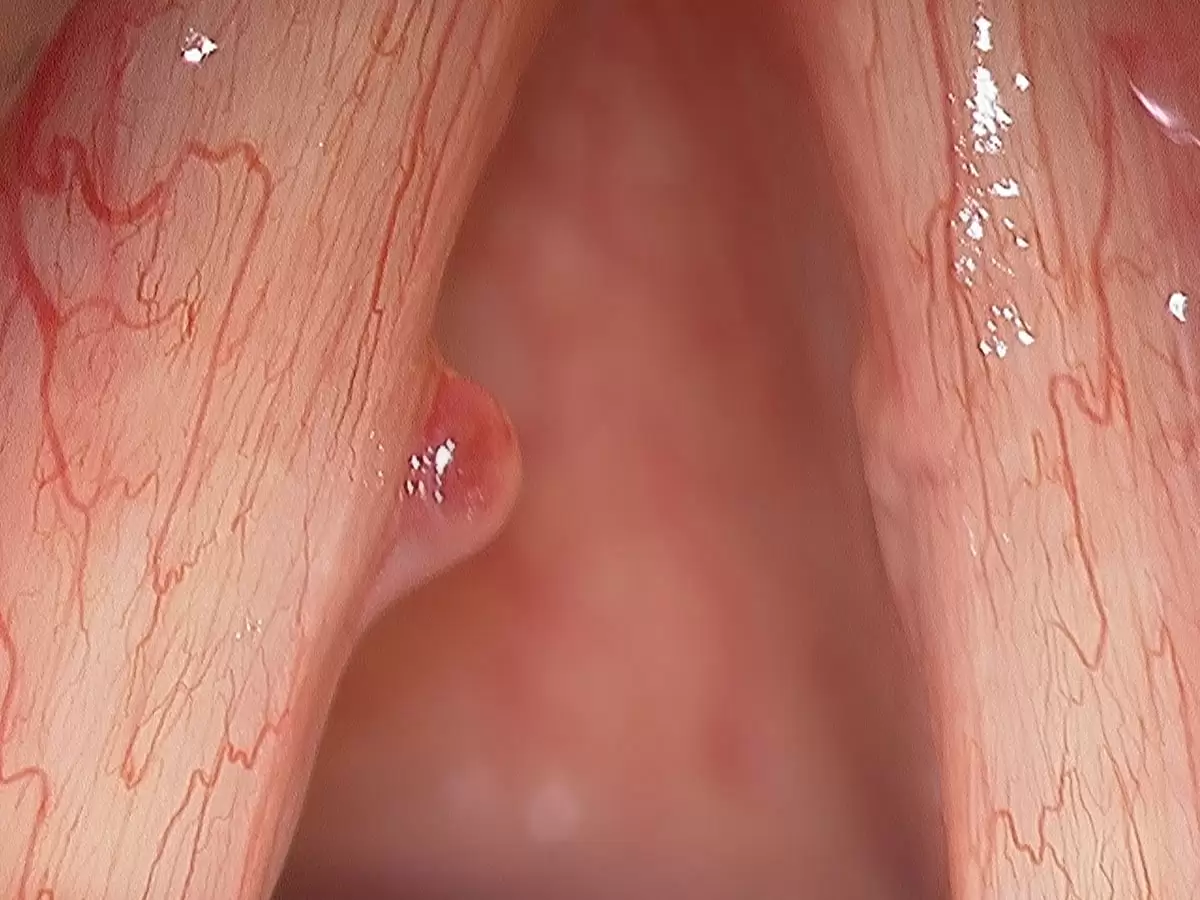 Pólipos Cuerdas Vocales y Edema de Reinke: Tratamiento Láser | Vocalia Otorrinolaringólogos ® Guadalajara